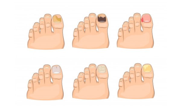 Кольцевидные наклейки на мозоли