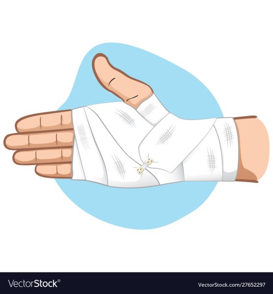 Повязка на руку при ожоге