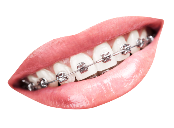 Брекеты на белом фоне