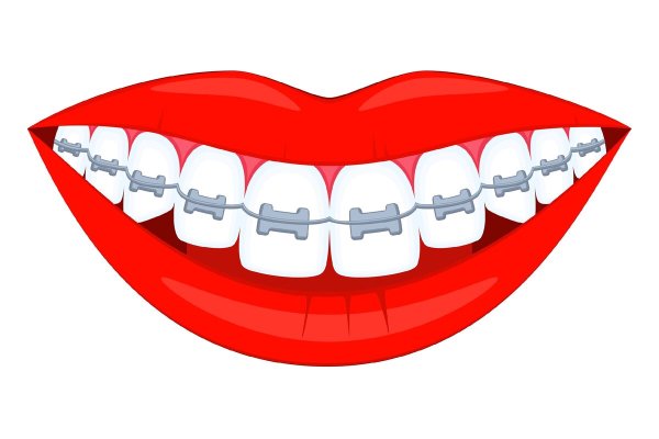 Рот с брекетами векторный