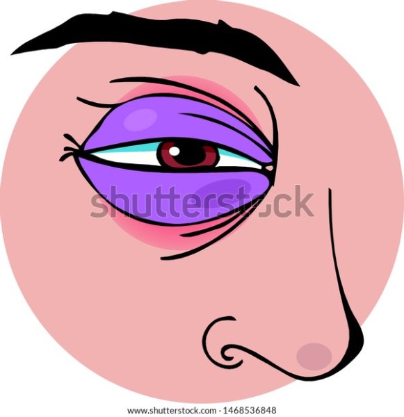 Синяк под глазом рисунок