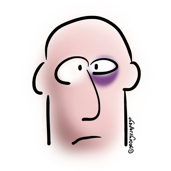 Синяк под глазом смешная