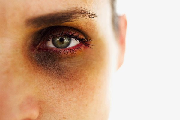 Огромные тёмные круги под глазами