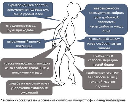 Прогрессирующая мышечная дистрофия Ландузи-Дежерина