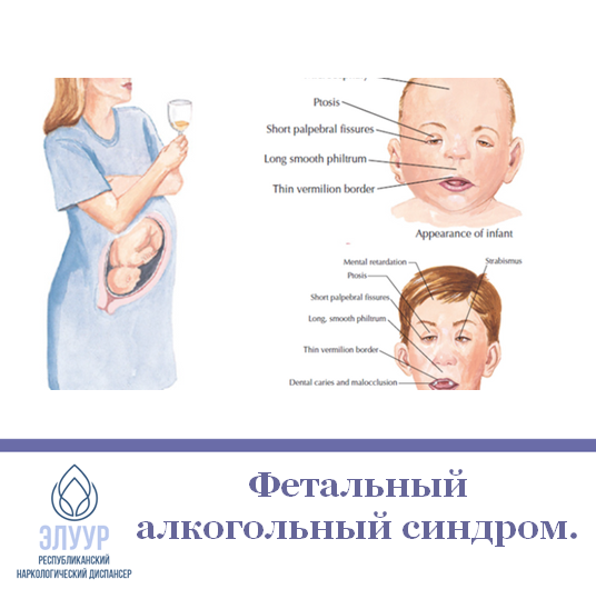 Плакаты День распространения информации о фетальном алкогольном синдроме (57 фото)