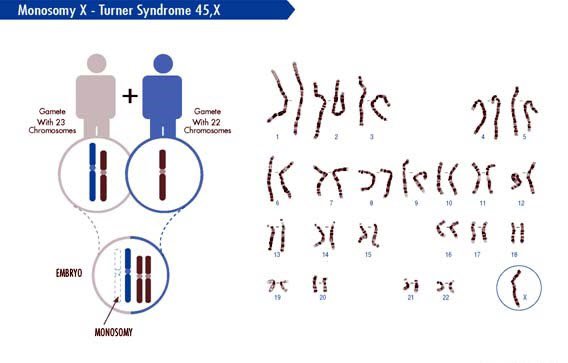 45x кариотип
