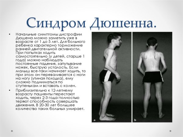 Прогрессирующая миопатия Дюшенна