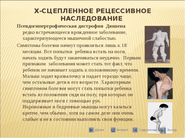 Псевдогипертрофическая Дюшенна