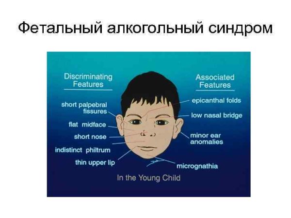 Фетальный алкогольный синдром у детей