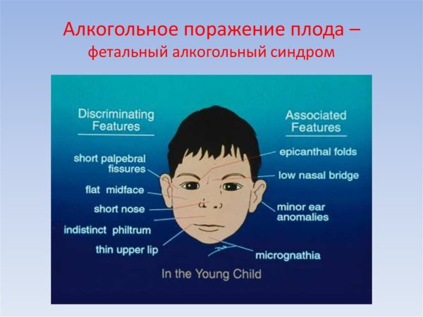 Fas фетальный алкогольный синдром