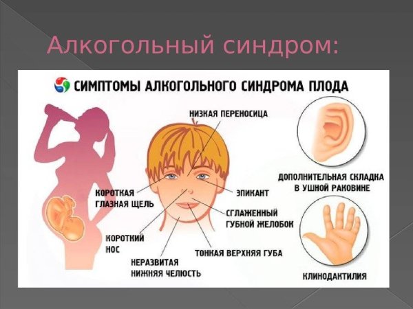 Фетальный алкогольный синдром плода
