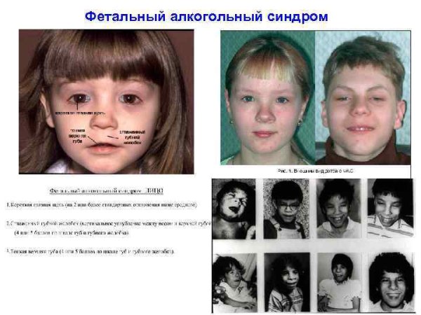 Эмбриональный алкогольный синдром