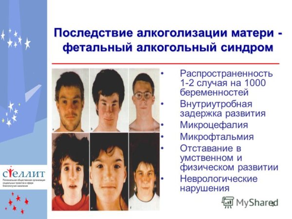 Алкогольный синдром плода