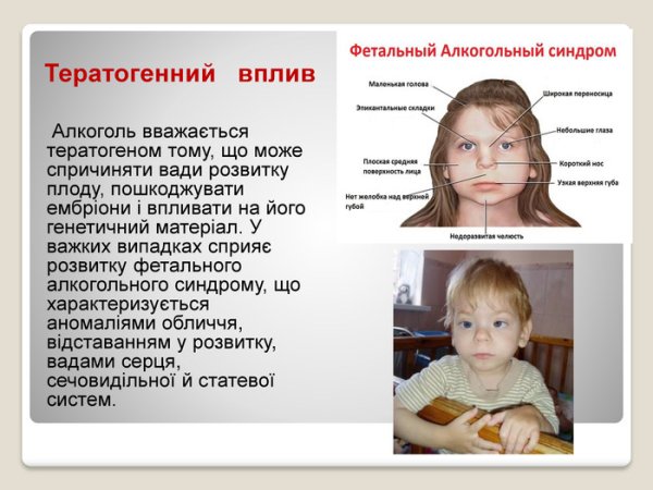 Фетальный алкогольный синдром
