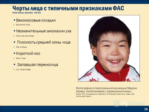 Фетальный алкогольный спектр