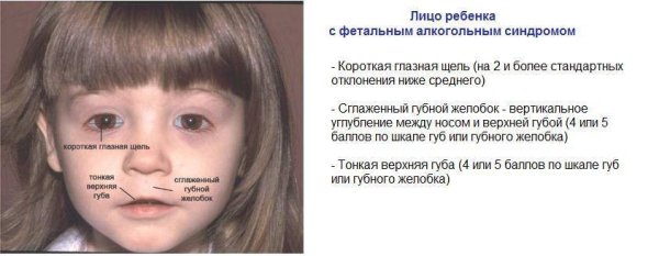 Фетальный алкогольный синдром у детей внешние признаки