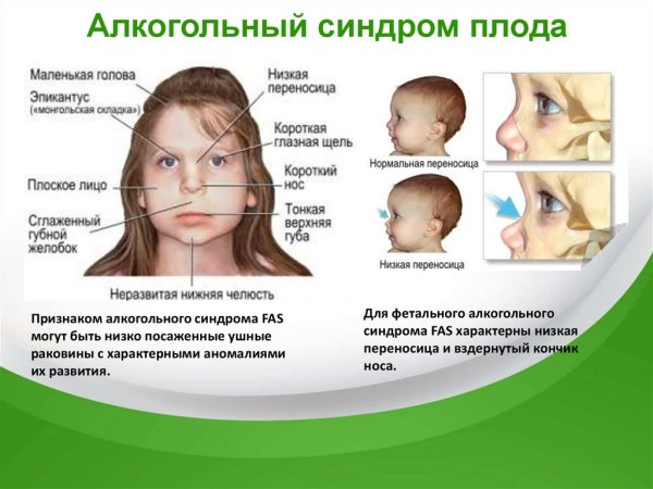 Фетальный алкогольный синдром плода