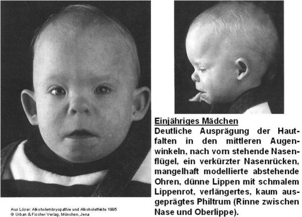 Алкогольный синдром плода