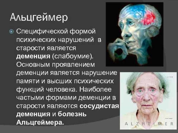 Сенильная деменция альцгеймеровского типа
