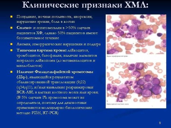 Хронический миелоцитарный лейкоз (ХМЛ)