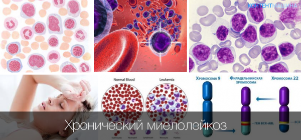 Миелоцитарный лейкоз картина крови