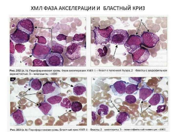 Миелолейкоз бластный криз