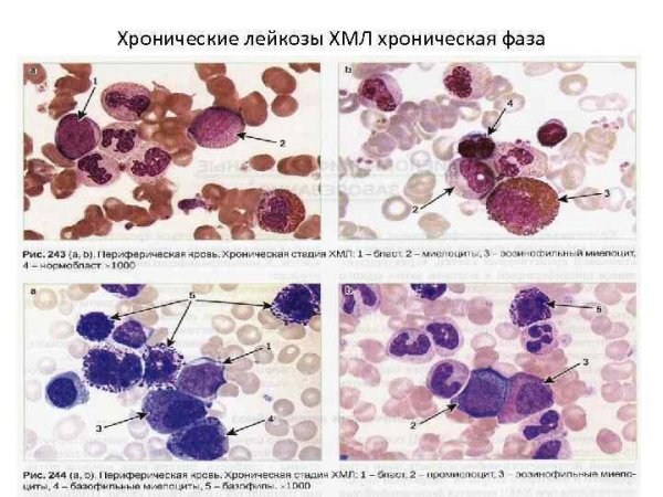 Хронический миелолейкоз картина крови схема