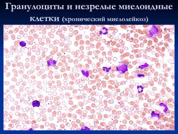 Хронический миелоидный лейкоз гистология