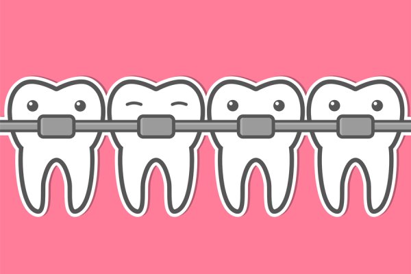 Брекеты мультяшные