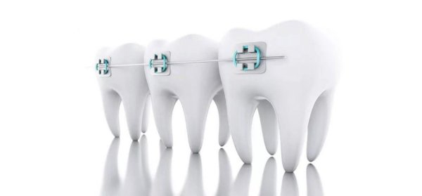 Зубы с брекетами на белом фоне