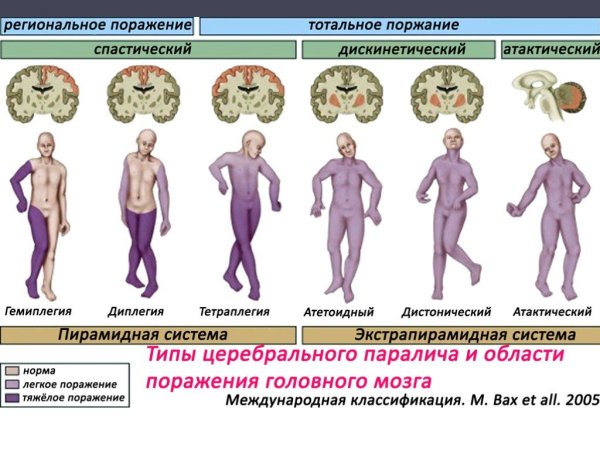 Поражение головного мозга при ДЦП