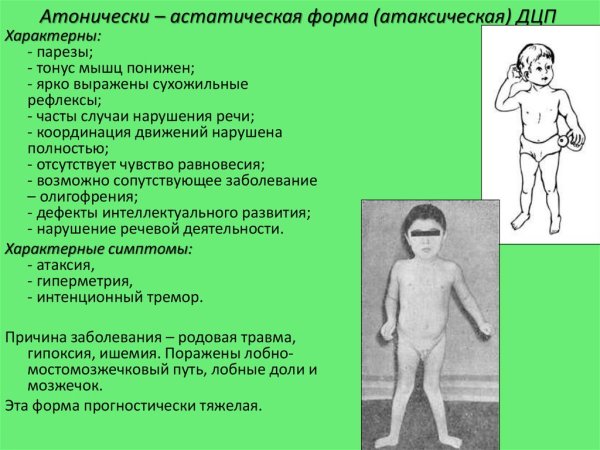 Атаксическая форма ДЦП У детей
