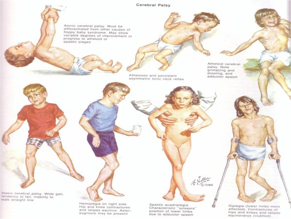 Детский церебральный паралич симптомы