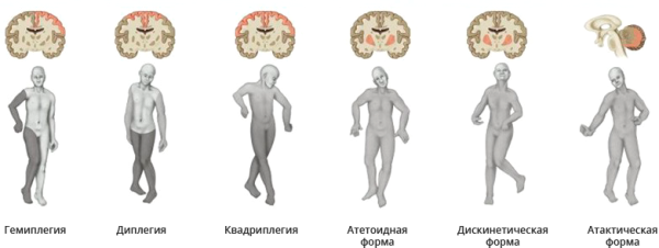 Легкая форма ДЦП У ребенка