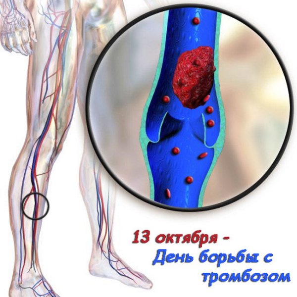 Всемирный день тромбоза