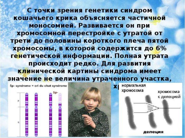 Синдром кошачьего крика (моносомия 5р)