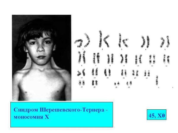 Синдром Шерешевского Тернера трисомия