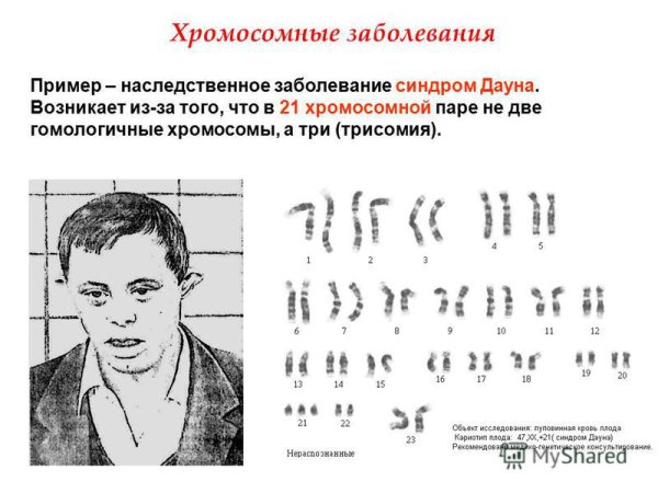 Синдром Дауна количество хромосом
