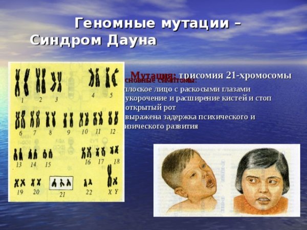Синдром Дауна хромосомная болезнь