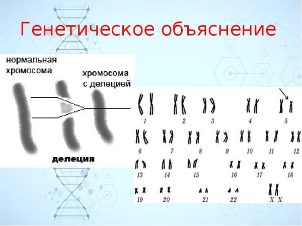 Синдром кошачьего крика (моносомия 5р)