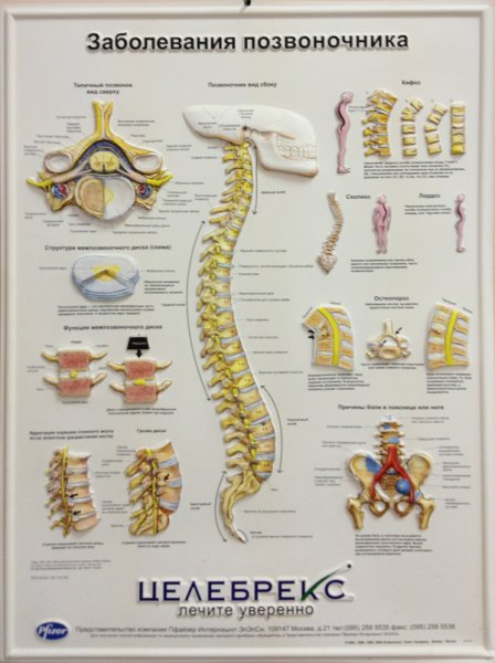 Заболевания позвоночника
