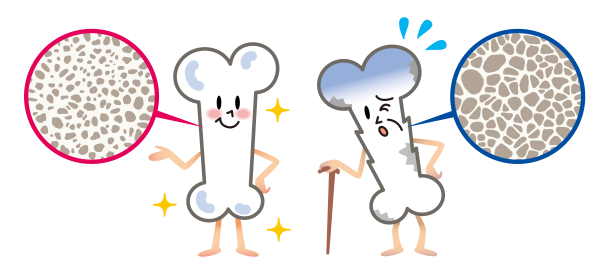 Остеопороз рисунок