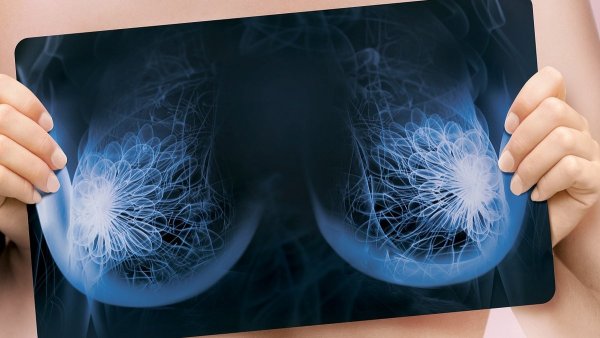 Маммография молочных желез