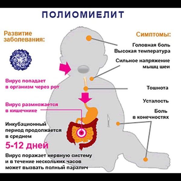 Специфические симптомы полиомиелита