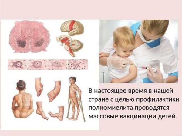 Профилактика полиомиелита