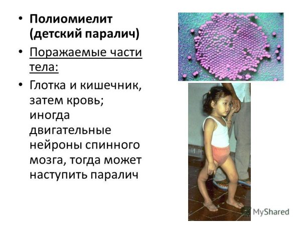 Вирус полиомиелита