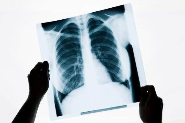 Рентгеноскопия легких