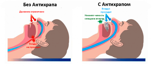 Причины Хрипа у мужчин