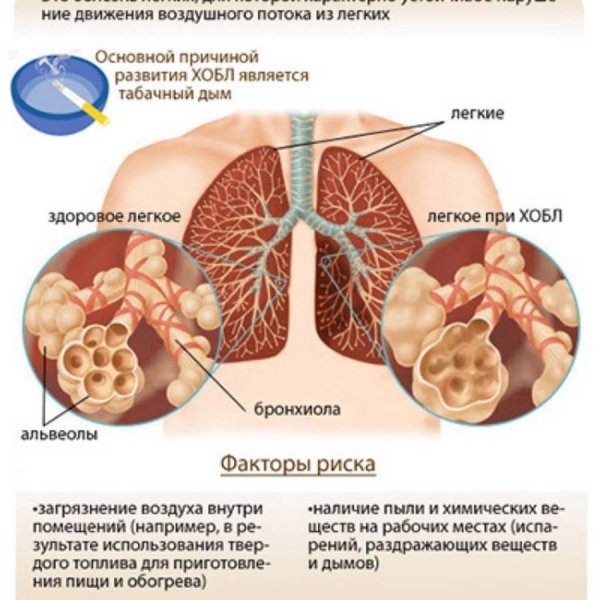 Хронические обструктивные заболевания легких