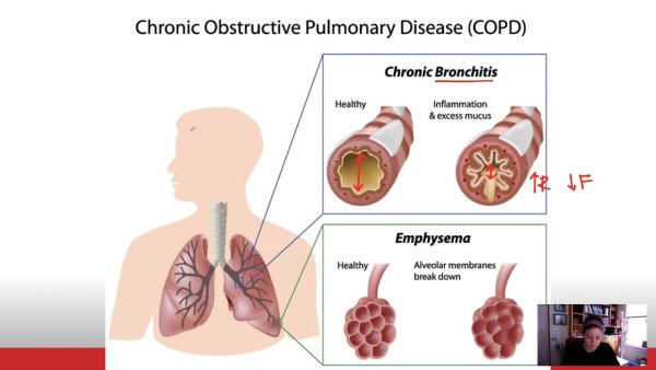 Chronic bronchitis Medical